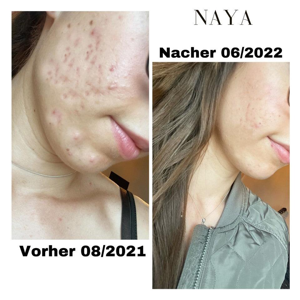 Acne: myths, diet and skin care routine , Sarah Zimmer , Skincare , NAYA , nayaglow.com
