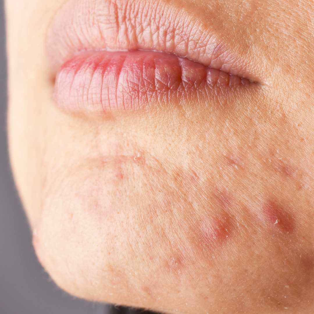 How to Clear Congestion Without Stripping the Skin