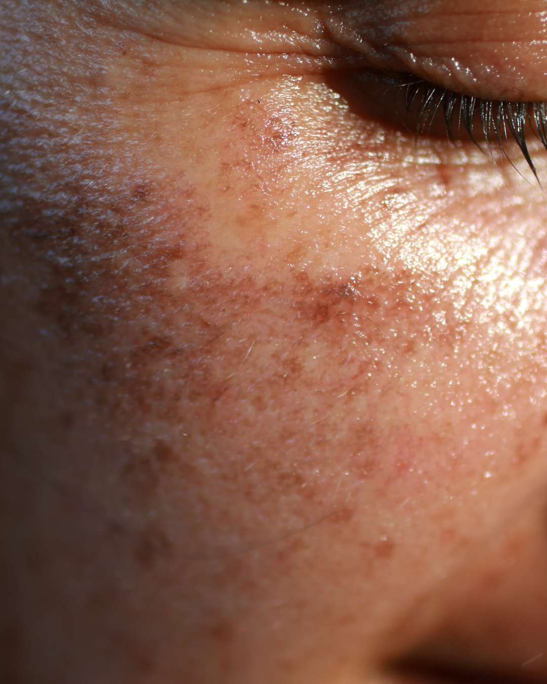 pigmentation, skincare, pigments on cheek