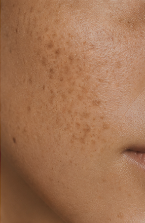 Pigmentation & Uneven Tone