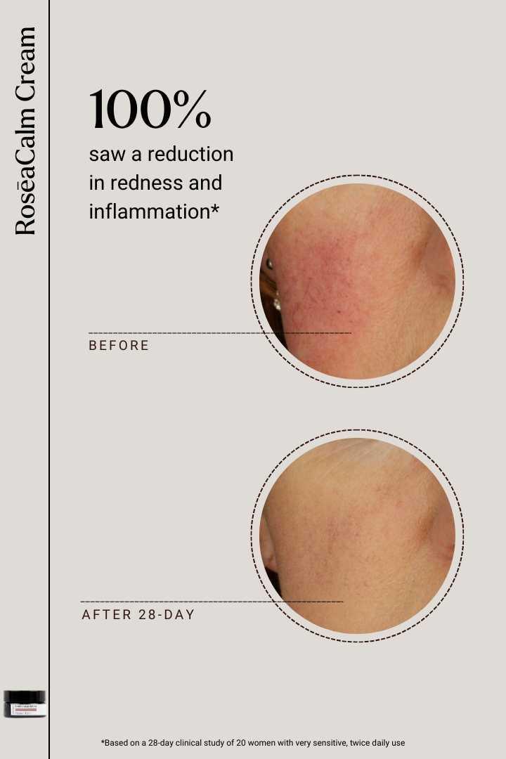 RosēaCalm Cream for Rosacea Relief | Soothe & Hydrate Skin – NAYA