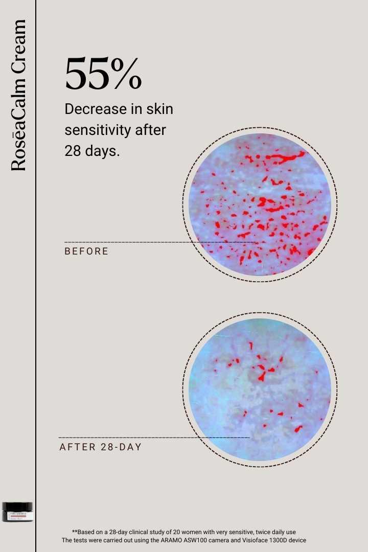 Calm Me | RosēaCalm Cream (Dedicated to Rosacea Skin)